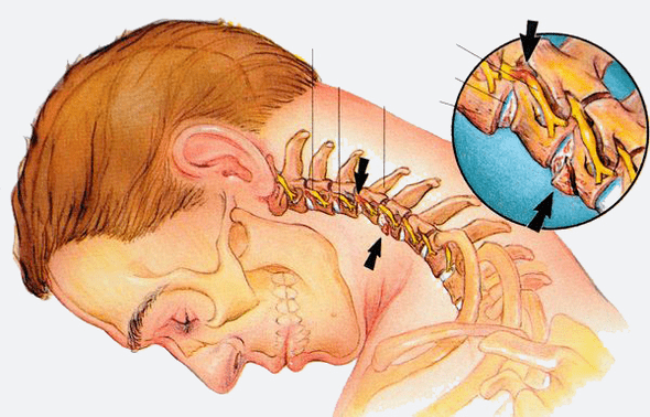 Stages of the osteochondrosis of the cervical spine